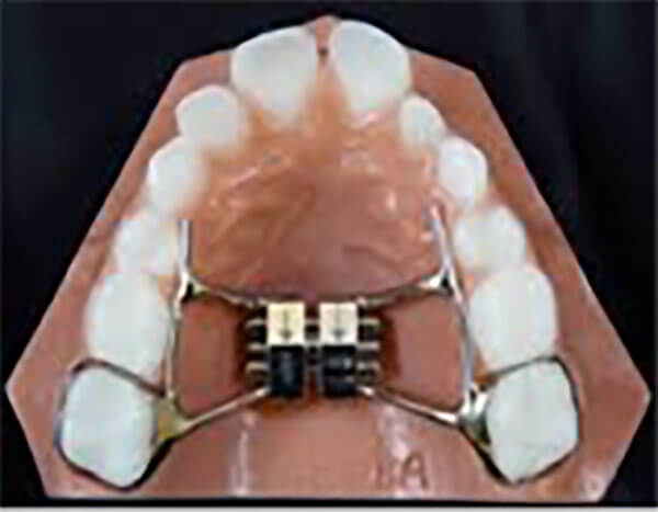 Palatal Expander Device (PED)